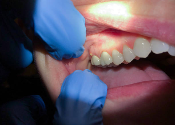 Best Emergency Broken Tooth Repair in Barton Creek, TX